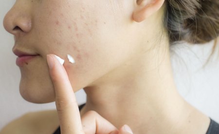 your-skin_sebium-sensitive_How-do-you-treat-acne-prone-skin