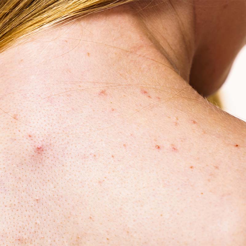 mulher com acne traseiro