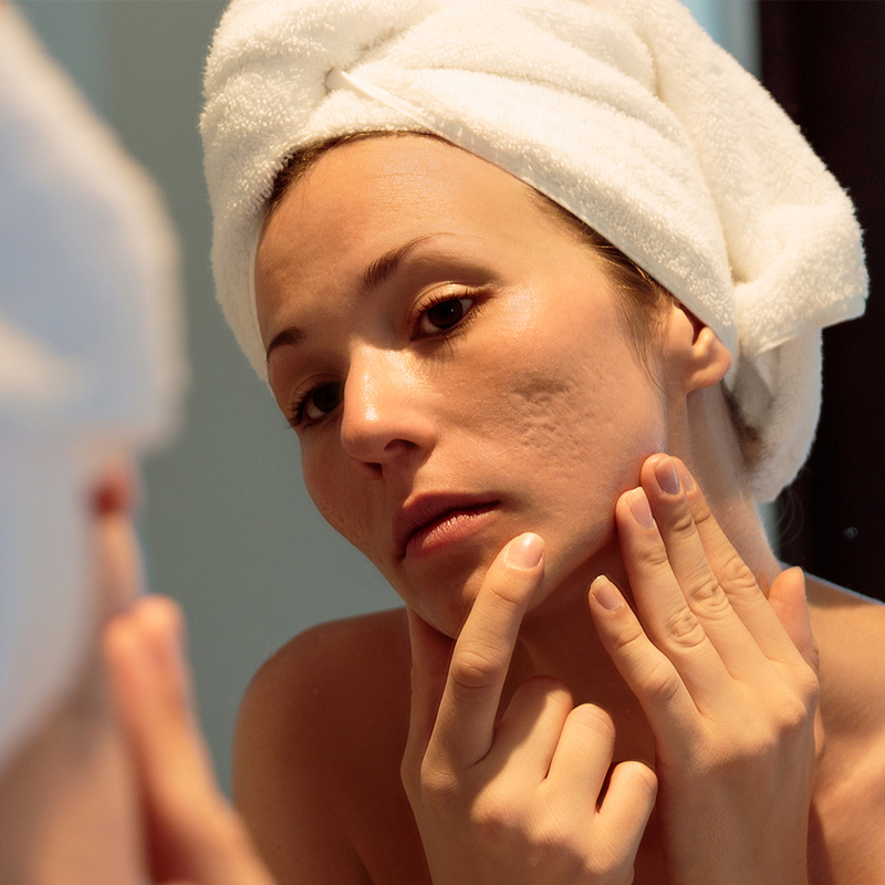 mulher com cicatrizes e marcas de acne