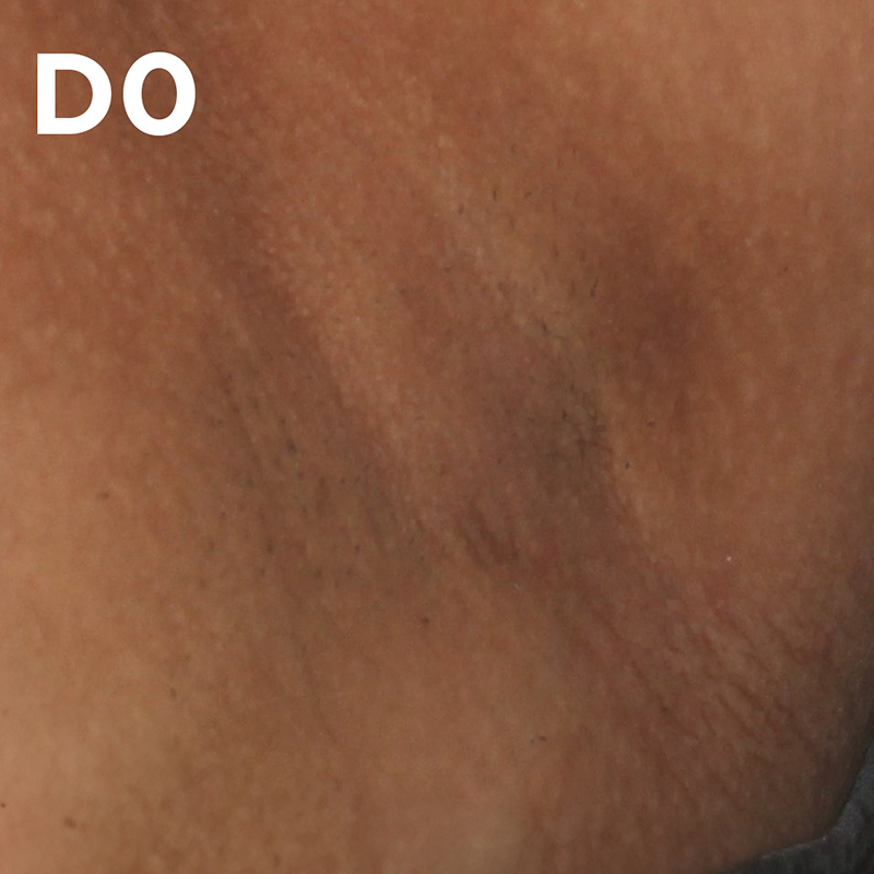 Clinicamente testado e aprovado em manchas escuras