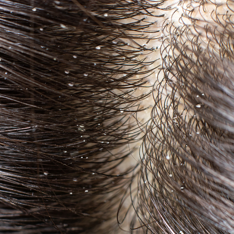 Caspa no cabelo
