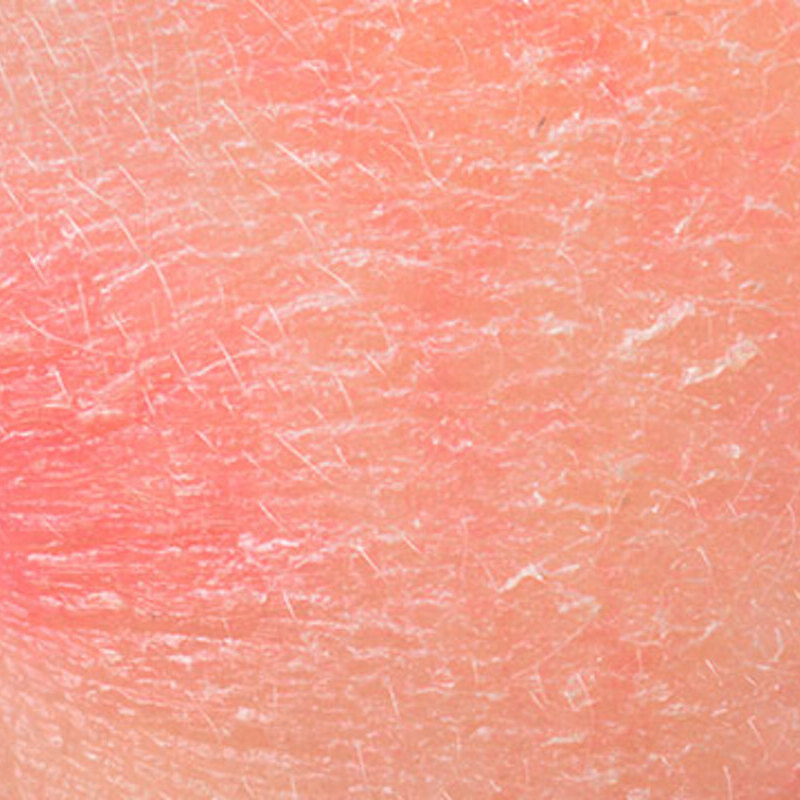 escalas de vermelhidão