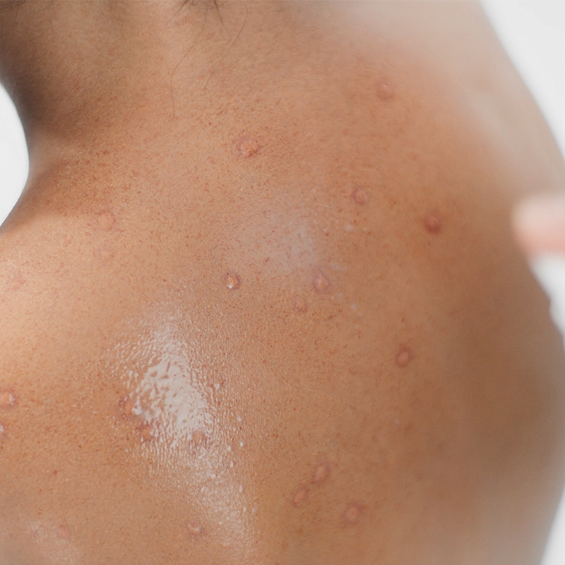 Parte traseira da mulher com cicatrizes da varicela