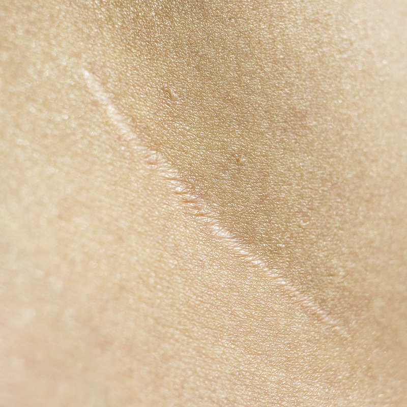 closeup enfraquecido e irritado da pele da cicatriz