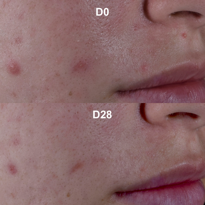 Antes / depois do Kerato +