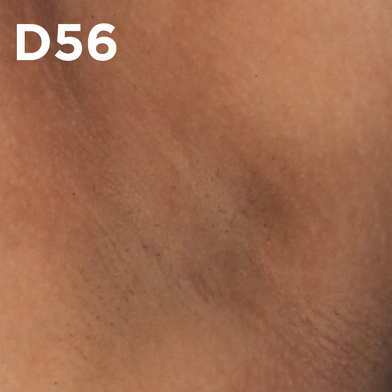 Clinicamente testado e aprovado em manchas escuras