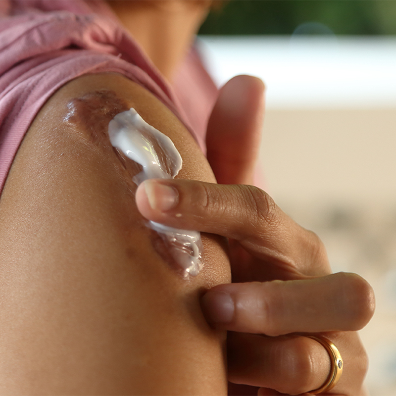 pele enfraquecida e irritada aplicando creme na cicatriz