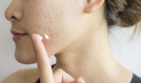 your-skin_sebium-sensitive_How-do-you-treat-acne-prone-skin