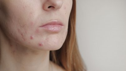 your-skin_sebium-sensitive_How-do-you-eliminate-acne