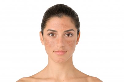 mulher com manchas de melasma no rosto 